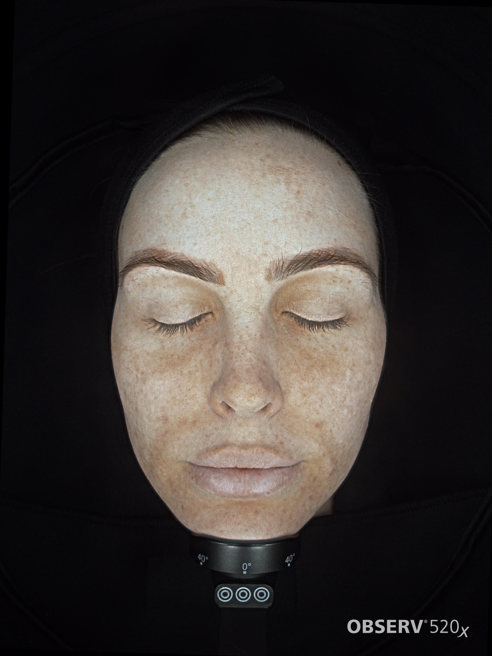 Carmen's approach on treating Melasma