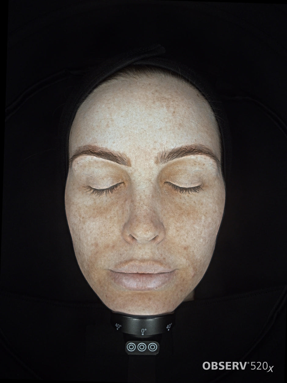 Carmen's approach on treating Melasma